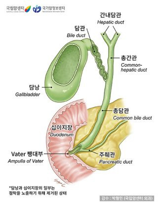 담도암 진단 및 치료